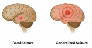 Two brains showing focal and generalized seizures. The focal seizure brain pinpoints a specific part of the brain. The generalized brain is completely affected.